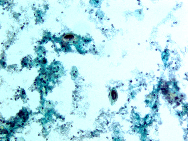 Figura 2. Esquistosoma Hematobium